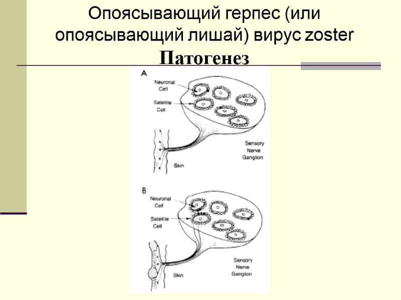 Опоясывающий герпес (или опоясывающий лишай) вирус zoster Патогенез